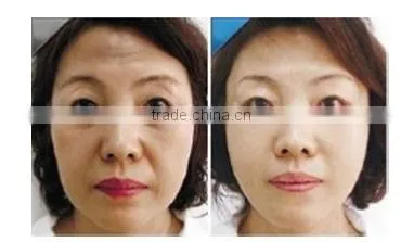 Beauty supply skin tightening thermagic rf machine