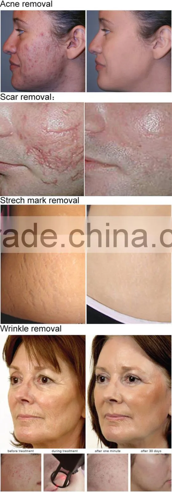 2014 new professional Glass RF tube 10600nm fractional co2 laser 40w co2 fractional laser for skin resurfacing