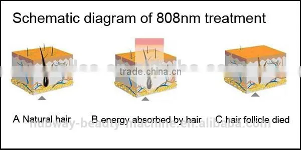 Medical Laser Equipo 808nm Diode Laser Brown Hair Removal Machine For Sale