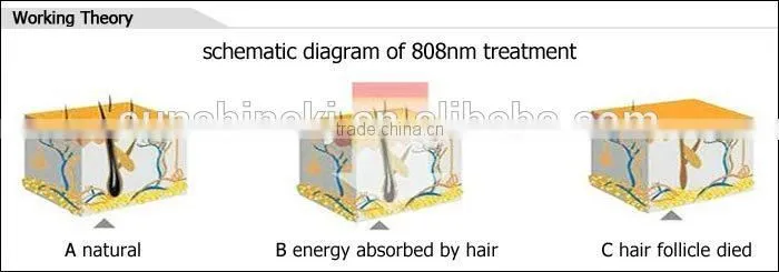 Hot selling TEC cooling system stationary 808nm diode laser hair removal depilador laser epila