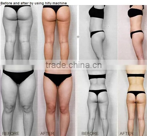 factory price multifunction liposonix hifu slimming machine
