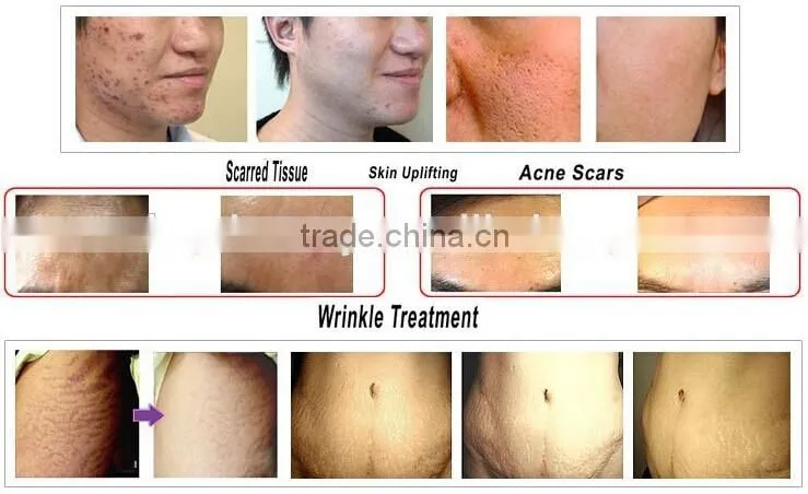ZGTS derma roller for acne scar removal dermaroller 540 with CE