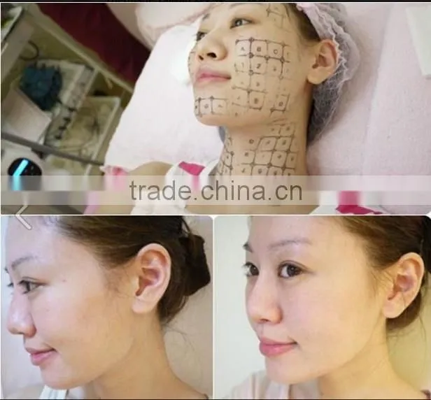 portable rf wrinkle removal face lifting device from weifang KM