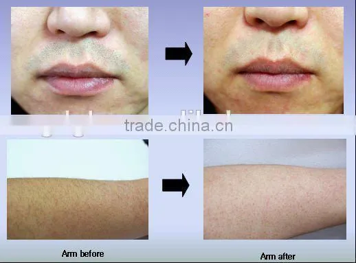 2015 Professional Pain-free 808nm diode laser hair removal machine for sale