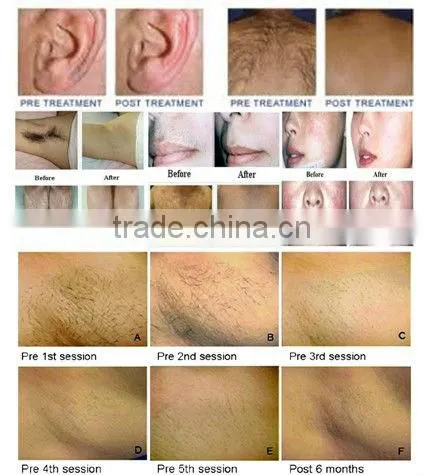 Immediately Result with Factory Promotion Price diode laser 808nm Hair Removal Machine