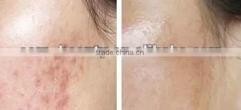 Facial hair remover electric threading hair remover personal hair removal C006