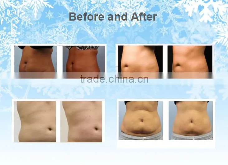 newest Cryolipolysis fat freeze Slimming lose weight machine for obesity