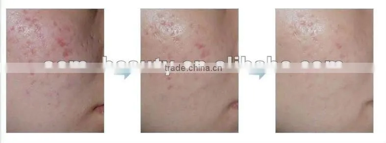 professional skin care products derma rolling machine dns derma roller L007