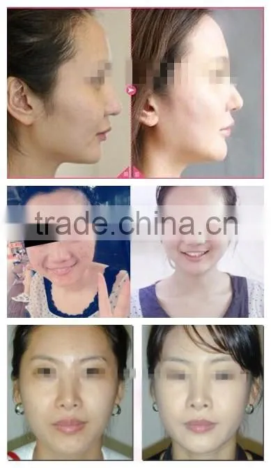 PDT/Photon LED Skin Rejuvenation/Professional PDT LED Light Therapy Equipment