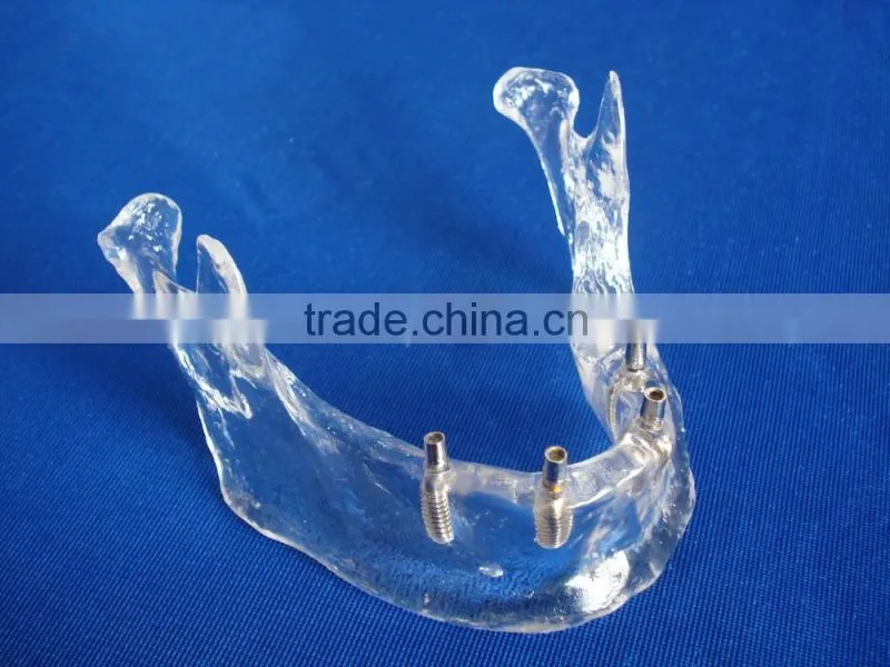 Hot Sale Transparant Mandibule Implant Model