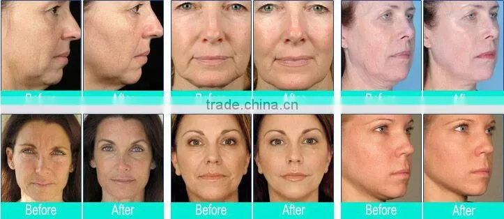 Portable hifu 40000 shots face lift ultrasound machine and wrinkle removal device