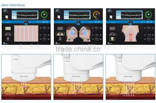 Magnetic resonance guided focused ultrasound effective skin tighten machine HFU10