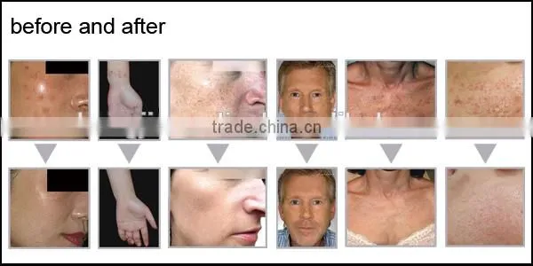 Fractional co2 laser machine stretch marks removal