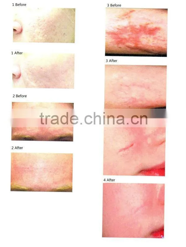 Pigmentaion treatment fractional CO2 laser K11 with CE and ISO certificate