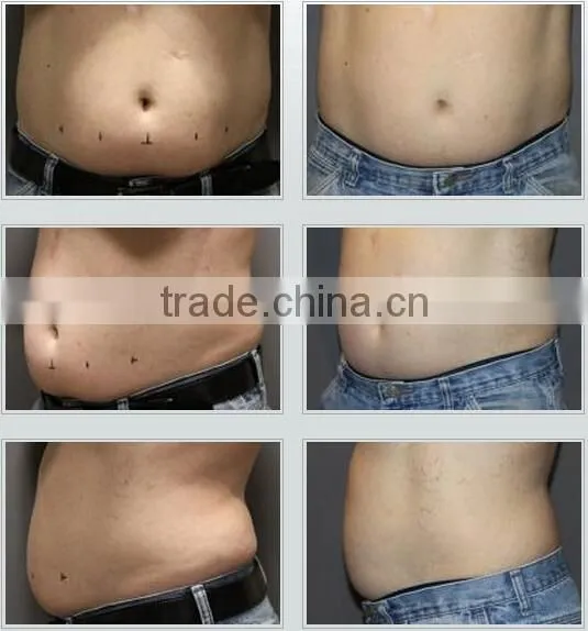 2015 Protable Cryo 2 Handles Kryolipolyse