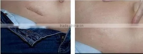 cosmetic implement freckle removal ce certificate derma roller 1080 needles changeable head body roller-L008