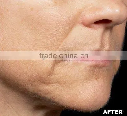 Hot Fractional & Micro needle RF machine wrinkle removal, face lifting/fractional microneedle radiofrequency