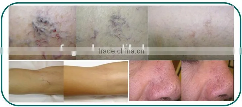 30W and effective vascular removal diode laser 980