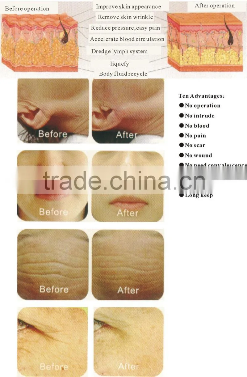 Monopolar rf machine/best rf skin tightening face lifting machine