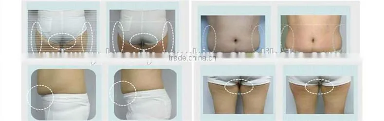 smart freezing cryolipolysis machine buy cryolipolysis machine