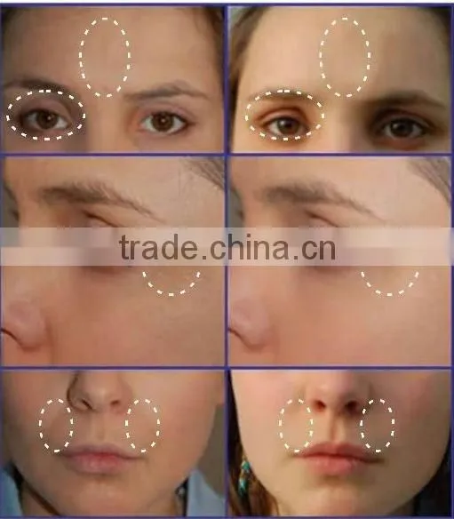 CE ISO approved multipolar radio frequency for skin tightening with 4 handles