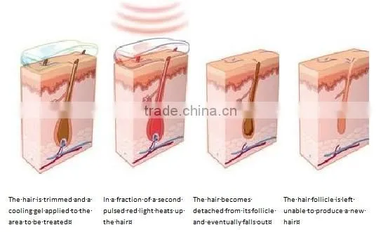 Bottom price hottest sale design device hot CE approved device for hair removal home ipl device