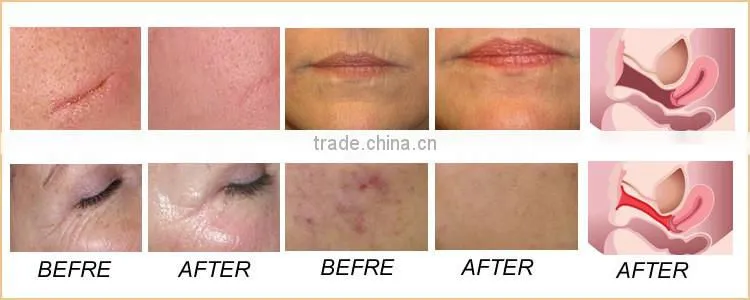 Vaginal laser tightening co2 laser vaginal rejuvenation treatment euqipment