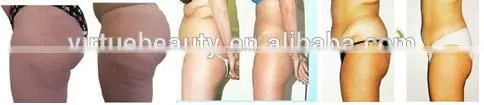 swollen veins laser 980nm / varicose veins laser 980nm