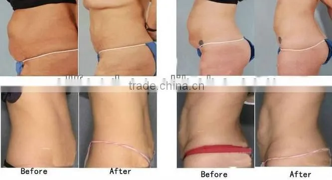 Hot sale cavitation RF lazer epilasyon weight loss equipment