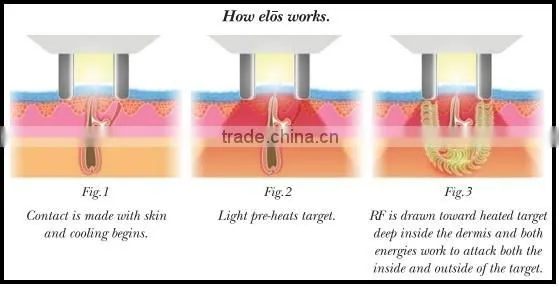 Hot sale suslaser IPL +RF laser ipl hair removal machine
