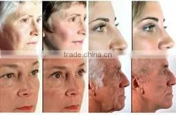 Real Medical Sapphire Crystal Portable Elight Skin Care Machine