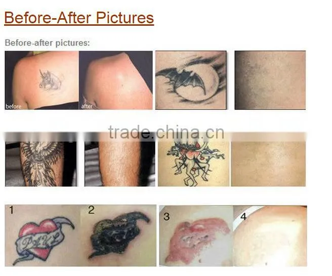 High quality factory price best laser tattoo removal machine