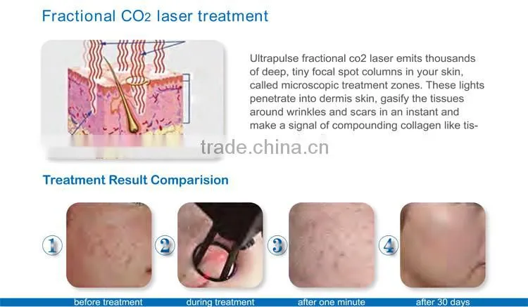 Professional 2017 newest 1-100ms pulse duration 30w fractional co2 laser treatment for acne scars