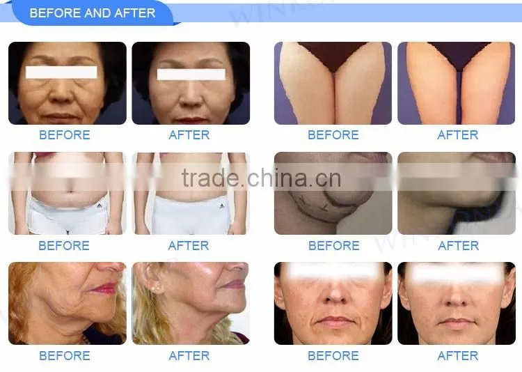 Winkon newest beauty & personal equipment hifu ultrasound machine & wrinkle removal hifu face lift