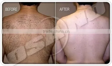 Germany Bars 808nm Diode Laser For Hair Removal Laser