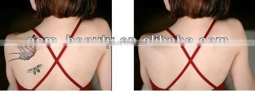 Good after-service Eyebrow removal/Color Tattoo removal machine laser machine-D003