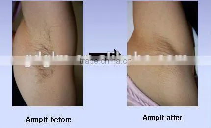 2015 Professional Pain-free 808nm diode laser hair removal machine for sale