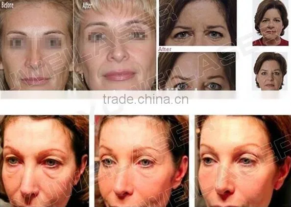 2016 hifu Face lifting wrinkle removal beauty machine HIFU u-one