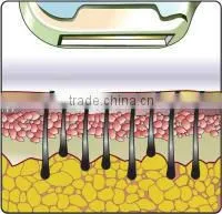 Pigment Removal IPL RF IPL Depilator