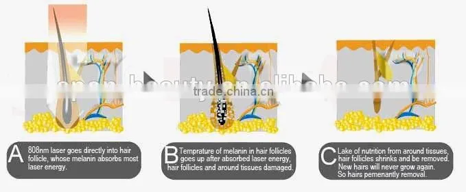 alma laser hair removal machine for sale