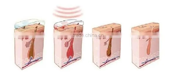 Best Elight IPL RF 3H photo rejuvenation machine