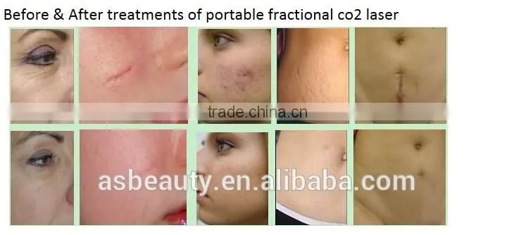 Portable 10600nm CO2 fractional laser equipment for scar removal/handheld co2 laser