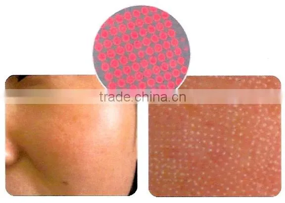Acne Treatment Skin Rejuvenation Skin Tightening er yag laser scar CO2 laser