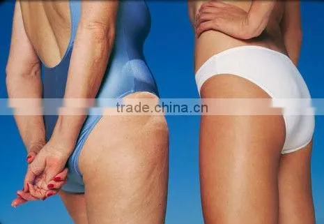 Ultrasonic Liposuction Equipment Weigth Loss Machine