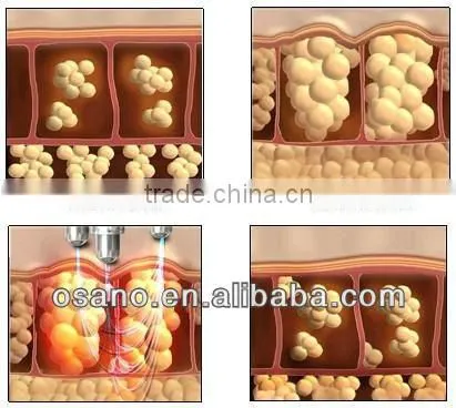 ultrasonic laser face lift machine home use