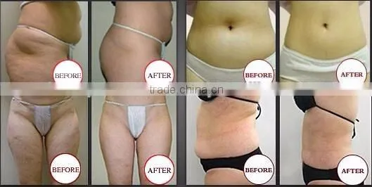 Medical CE approved Cavitation vacuum freezing fat cell cryo slimming machine