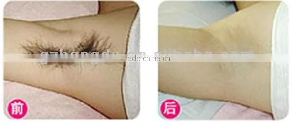 2013 Newest product! permanent lazer home hair removal device for the whole body BD-J005