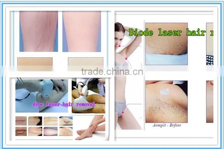 Aroma epilator laser hair removal machine diode