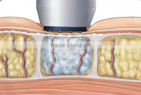 Ultrasonic Liposuction Equipment Weigth Loss Machine