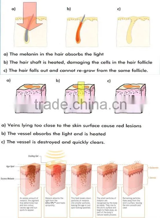 NUBWAY good quality portable multifunctional ipl / hair removal device ipl